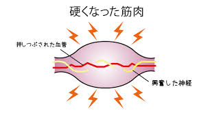 硬くなった筋肉.jpg